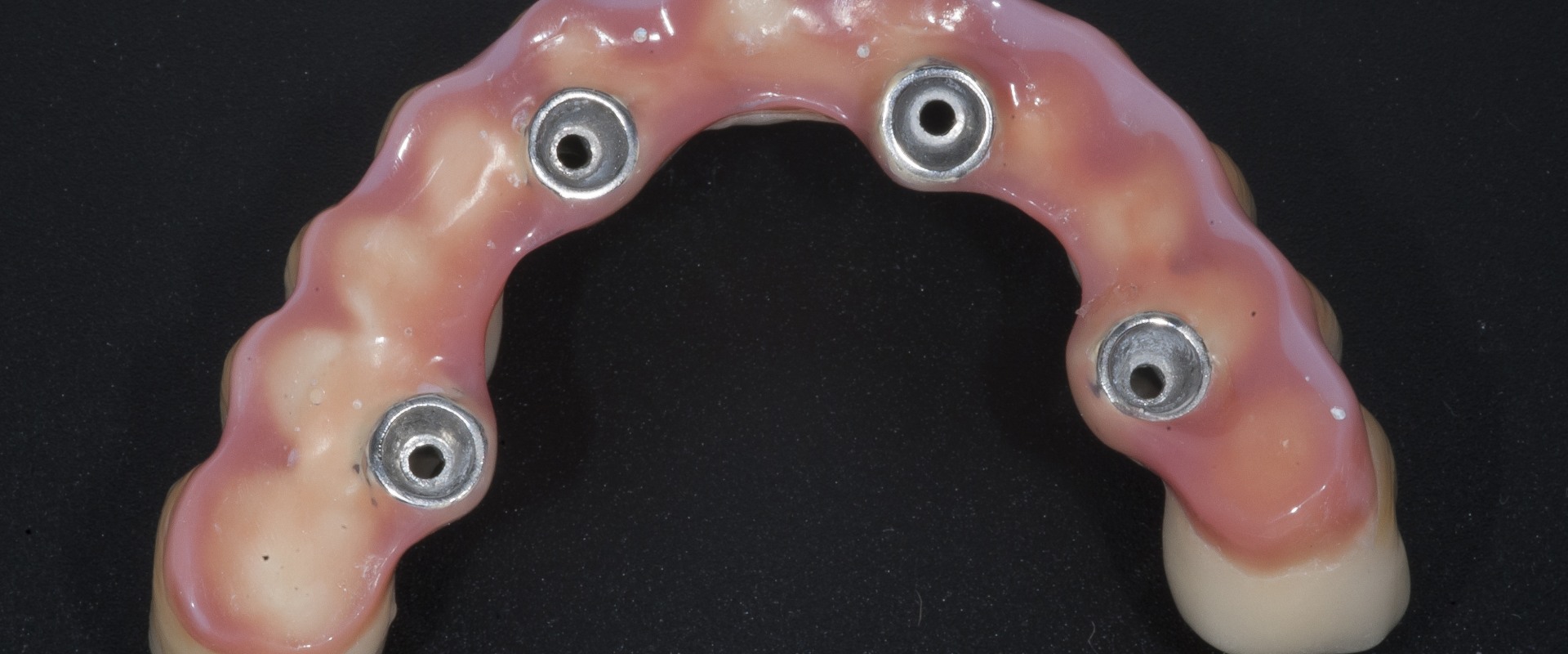 Do Prosthodontists Do Implants? A Comprehensive Guide