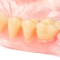 Are prosthodontics dentures?