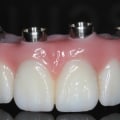 Do Prosthodontists Pull Teeth? Expert Advice on Restoring Your Smile