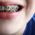 What is the Difference Between a Prosthodontist and Orthodontist?