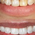 Song Cosmetic Dentistry: Prosthodontist in Beverly Hills