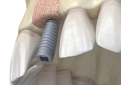 Does a prosthodontist do bone grafts?