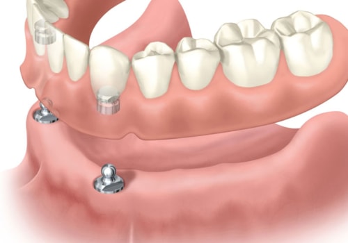 Finding the Best Prosthodontist Near You