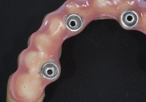 Do prosthodontists do implants?